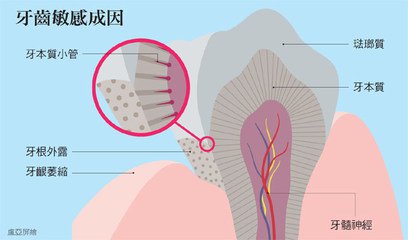 牙齿敏感的原因